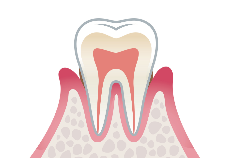 歯周炎（軽度）