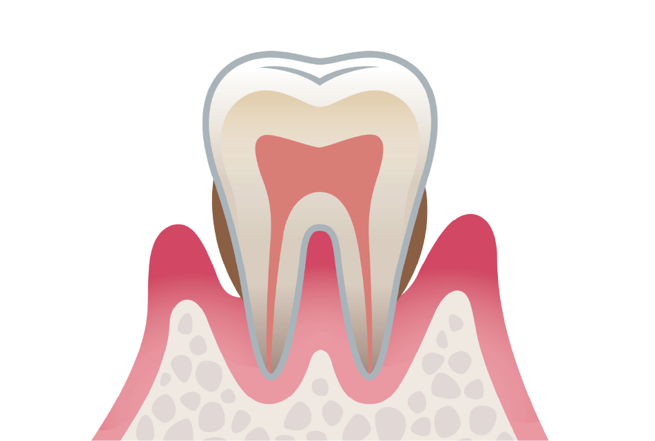 歯周炎（中度）