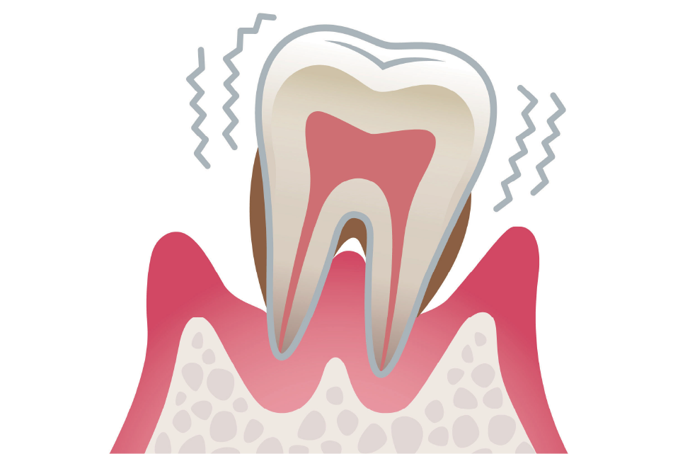 歯周炎（重度）
