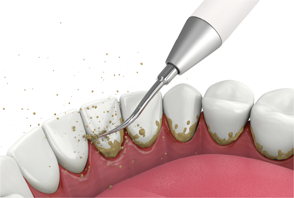 歯垢や歯石の除去
